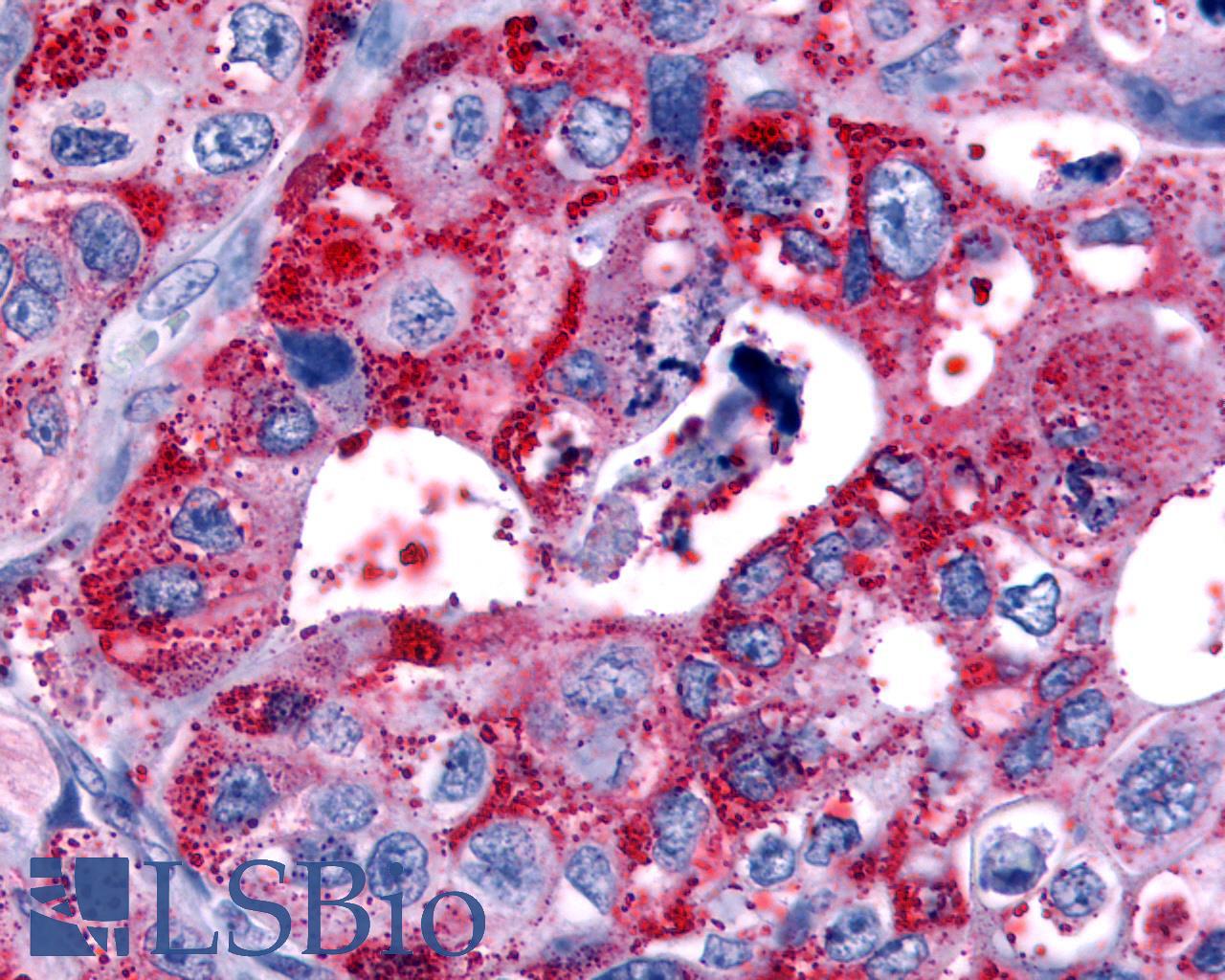 HRH4 / Histamine H4 Receptor Antibody - Pancreas, carcinoma
