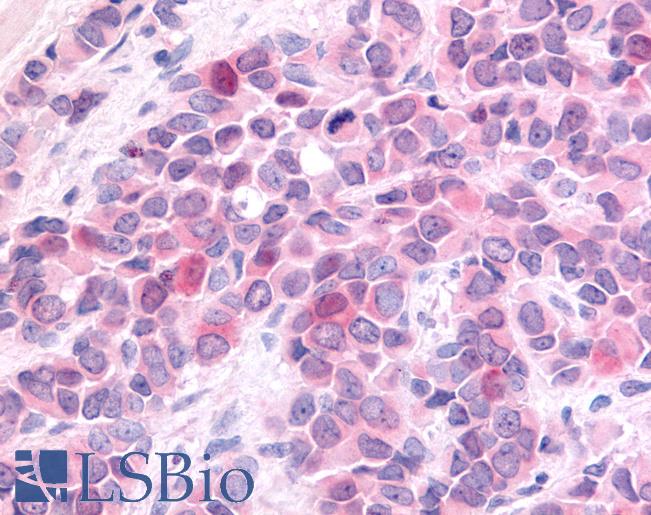 HUNK / B19 Antibody - Anti-HUNK / B19 antibody IHC of human Breast, Carcinoma. Immunohistochemistry of formalin-fixed, paraffin-embedded tissue after heat-induced antigen retrieval.