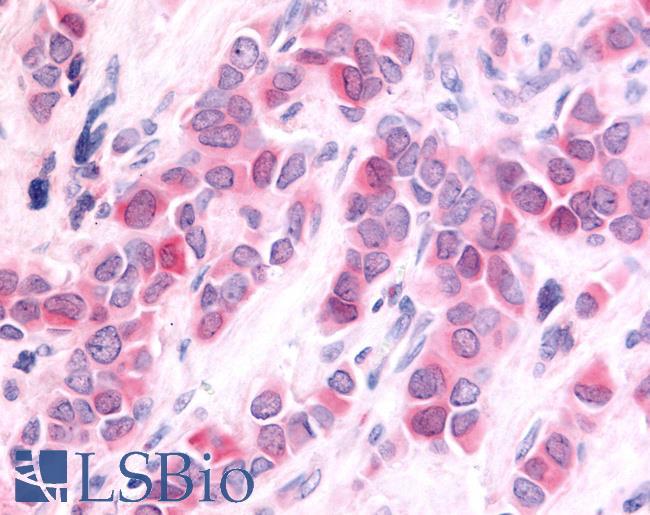 HUNK / B19 Antibody - Breast carcinoma