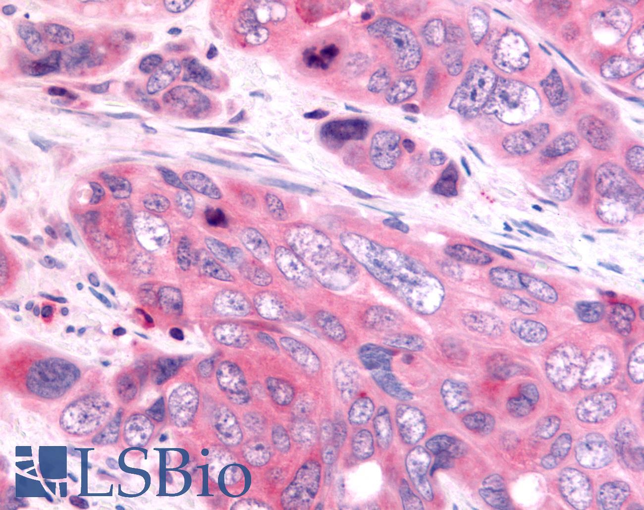 HUNK / B19 Antibody - Colon, Carcinoma