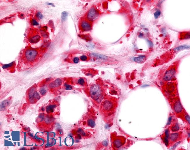 HUNK / B19 Antibody - Breast, Carcinoma