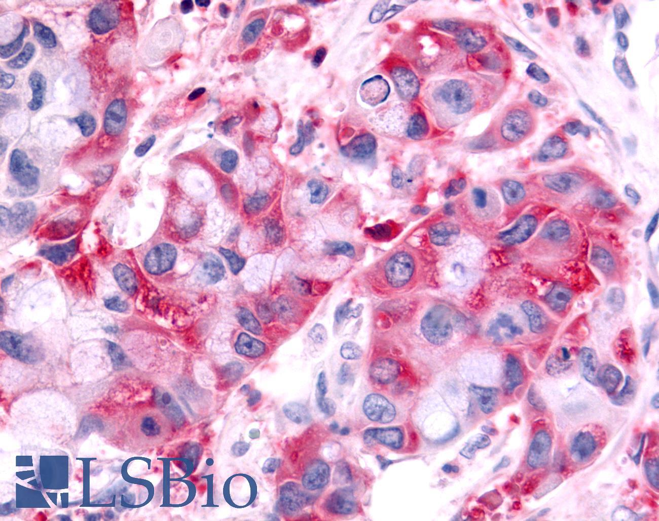 HUNK / B19 Antibody - Pancreas, carcinoma