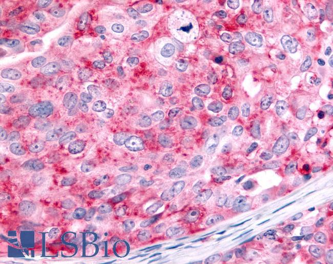 HUNK / B19 Antibody - Ovary, carcinoma