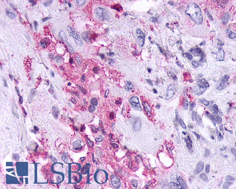 KISS1R / GPR54 Antibody - Anti-KISS1R / GPR54 antibody IHC of human Pancreas, Carcinoma. Immunohistochemistry of formalin-fixed, paraffin-embedded tissue after heat-induced antigen retrieval.