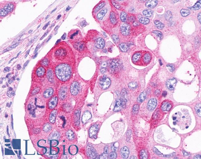 LPAR2 / EDG4 Antibody - Colon, Carcinoma