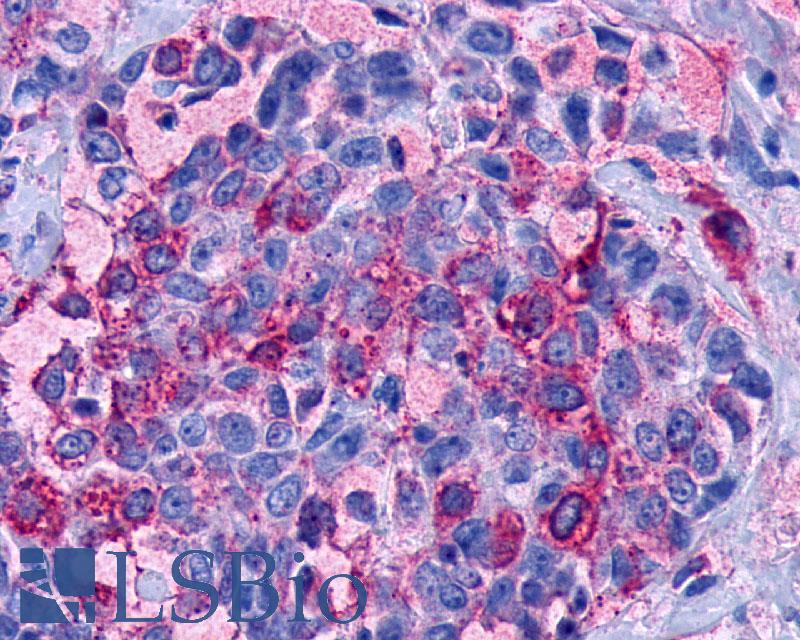 LPAR3 / LPA3 / EDG7 Antibody - Breast, Carcinoma