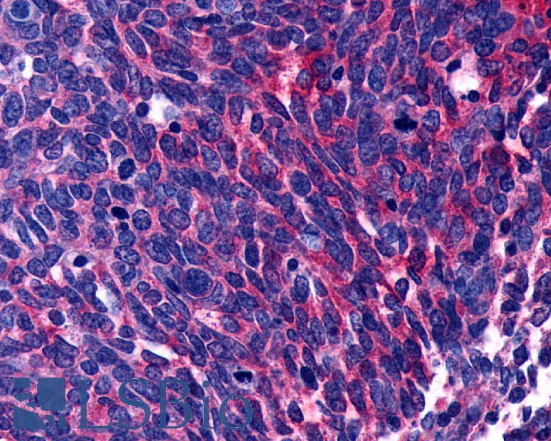 LPAR3 / LPA3 / EDG7 Antibody - Lung, small cell carcinoma