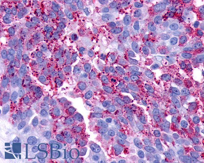 LPAR3 / LPA3 / EDG7 Antibody - Ovary, Carcinoma