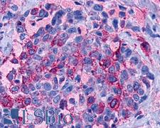 LPAR3 / LPA3 / EDG7 Antibody - Anti-LPAR3 / LPA3 / EDG7 antibody IHC of human Breast, Carcinoma. Immunohistochemistry of formalin-fixed, paraffin-embedded tissue after heat-induced antigen retrieval.