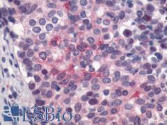 LPAR4 / GPR23 Antibody - Breast, adenocarcinoma