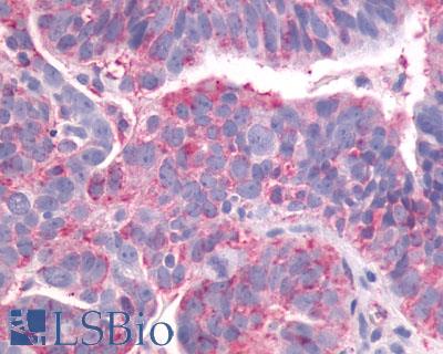 LPAR4 / GPR23 Antibody - Ovary, Carcinoma