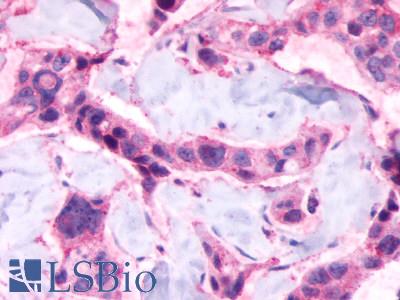 LPAR6 / P2RY5 / P2Y5 Antibody - Breast, adenocarcinoma