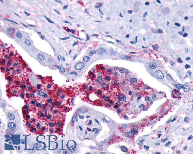 LTB4R2 / BLT2 Antibody - Anti-LTB4R2 / BLT2 antibody IHC of human Pancreas, Carcinoma and Leukocytes. Immunohistochemistry of formalin-fixed, paraffin-embedded tissue after heat-induced antigen retrieval.