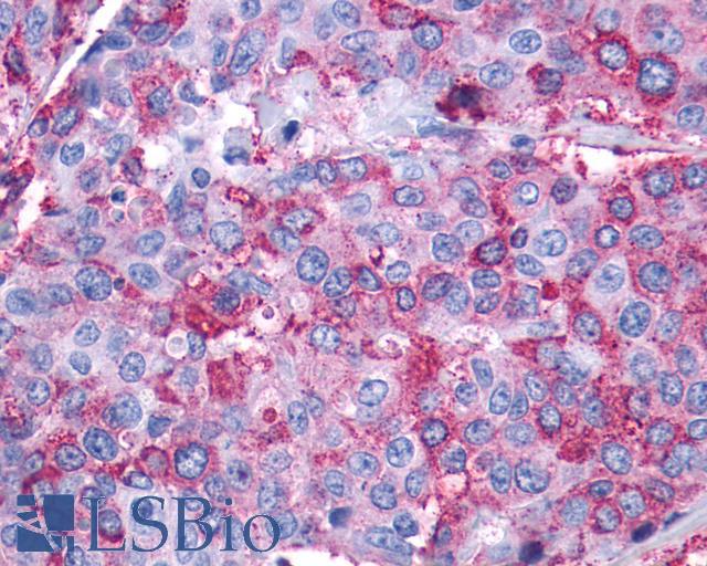LTB4R2 / BLT2 Antibody - Breast, carcinoma