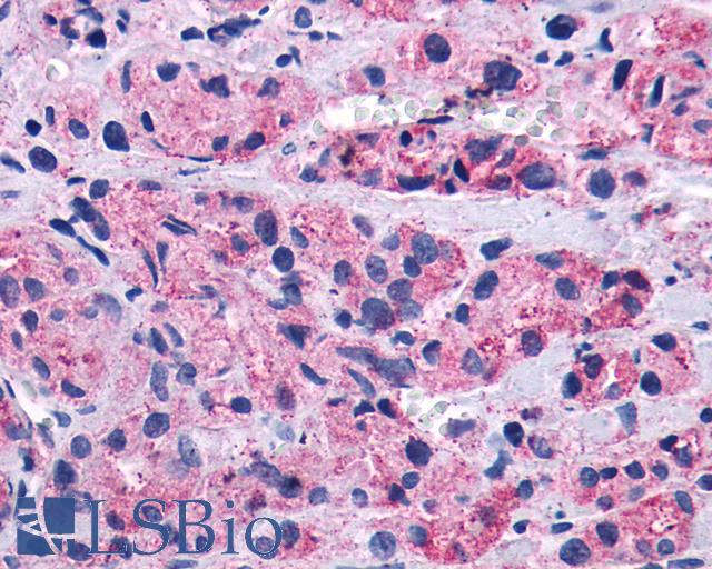 LTB4R2 / BLT2 Antibody - Prostate, Carcinoma
