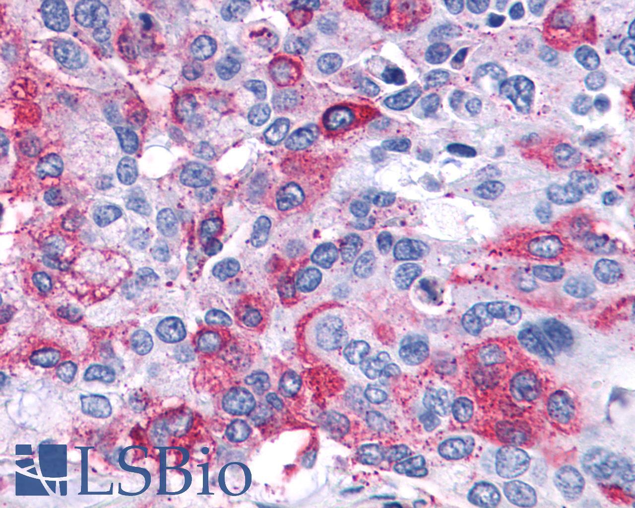 LTB4R2 / BLT2 Antibody - Lung, Adenocarcinoma