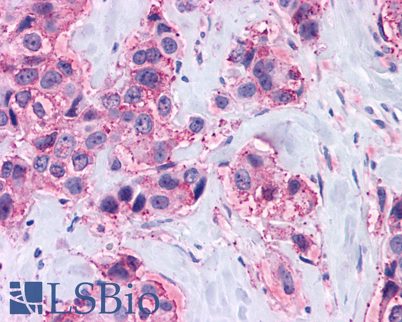 MAS1 / MAS Antibody - Breast, Carcinoma