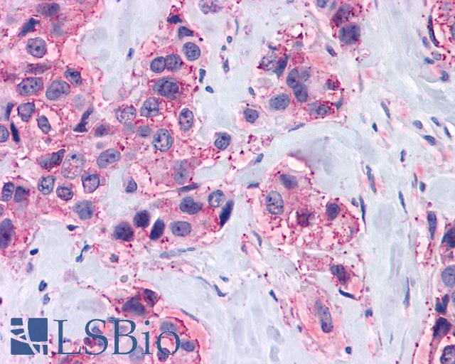 MAS1 / MAS Antibody - Breast carcinoma