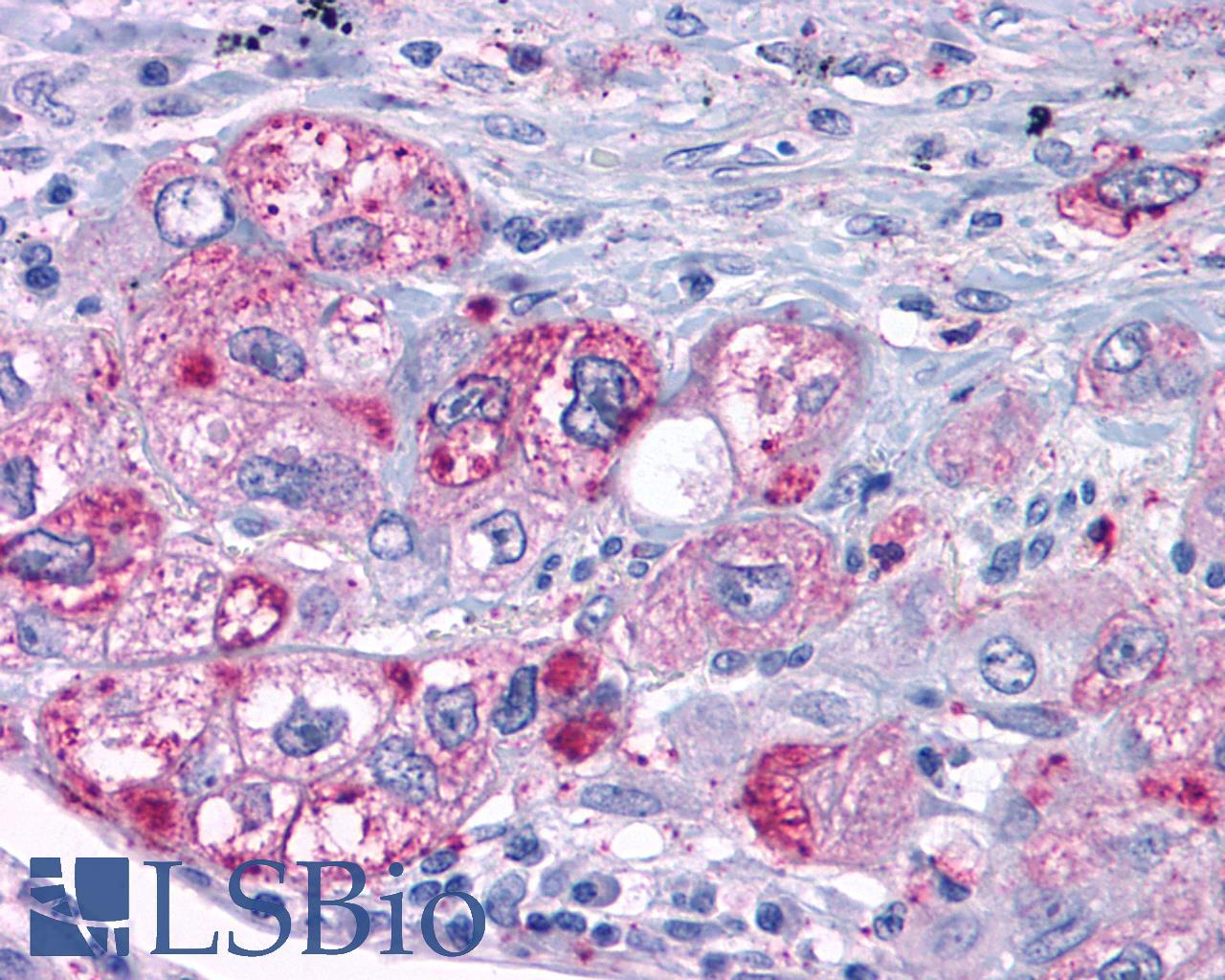 MAS1 / MAS Antibody - Lung, non small-cell carcinoma