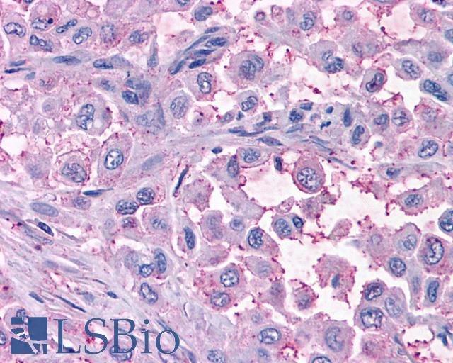 MAS1 / MAS Antibody - Pancreas, Carcinoma