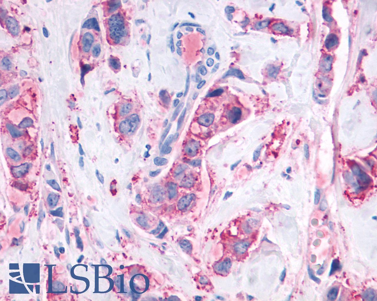 MAS1 / MAS Antibody - Breast, Carcinoma