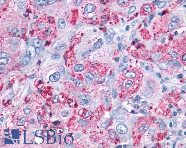 MAS1 / MAS Antibody - Lung, non small-cell carcinoma