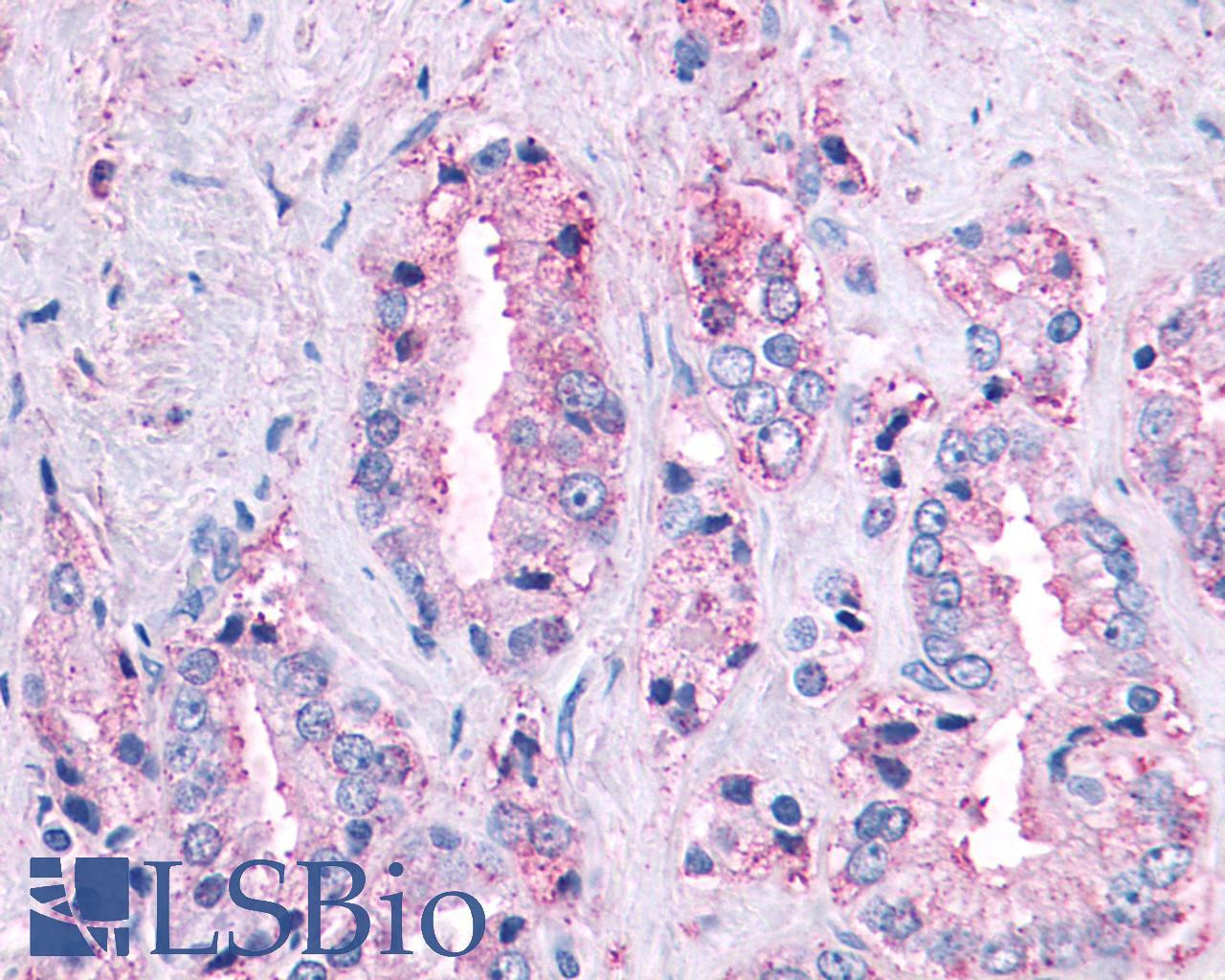 MAS1 / MAS Antibody - Prostate, Carcinoma