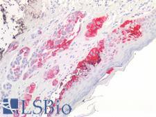 Melanoma Antibody - Human Skin, Malignant Melanoma: Formalin-Fixed, Paraffin-Embedded (FFPE)