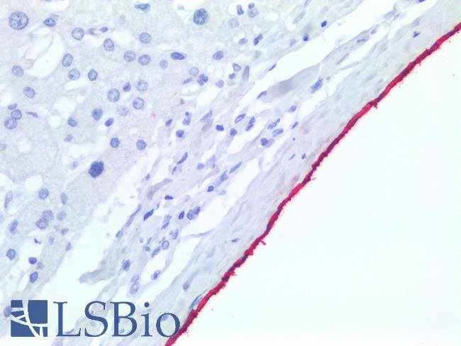 Mesothelioma Antibody - Human Liver: Formalin-Fixed, Paraffin-Embedded (FFPE)