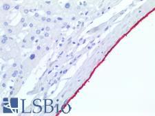 Mesothelioma Antibody - Human Liver: Formalin-Fixed, Paraffin-Embedded (FFPE)