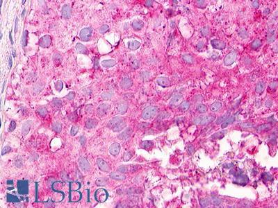 MLNR/GPR38/Motilin Receptor Antibody - Breast, Carcinoma