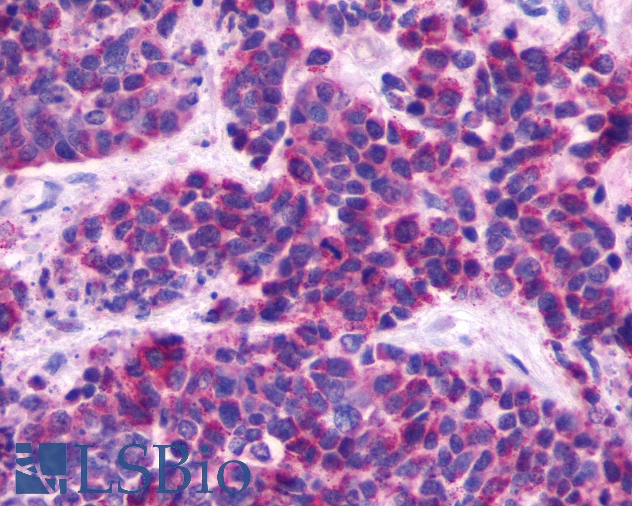 MRGPRE / MRGE Antibody - Anti-MRGPRE / MRGE antibody IHC of human Lung, Small Cell Carcinoma. Immunohistochemistry of formalin-fixed, paraffin-embedded tissue after heat-induced antigen retrieval.