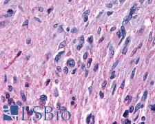 MRGPRF Antibody - Anti-MRGPRF antibody IHC of human Brain, Glioblastoma. Immunohistochemistry of formalin-fixed, paraffin-embedded tissue after heat-induced antigen retrieval.