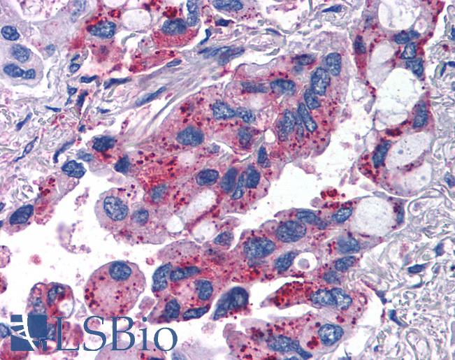 MRGPRX2 / MRGX2 Antibody - Anti-MRGPRX2 / MRGX2 antibody IHC of human Lung, Non-Small Cell Carcinoma. Immunohistochemistry of formalin-fixed, paraffin-embedded tissue after heat-induced antigen retrieval.