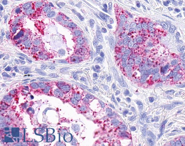 MRGPRX3 / MRGX3 Antibody - Anti-MRGPRX3 / MRGX3 antibody IHC of human Lung, Adenocarcinoma. Immunohistochemistry of formalin-fixed, paraffin-embedded tissue after heat-induced antigen retrieval.