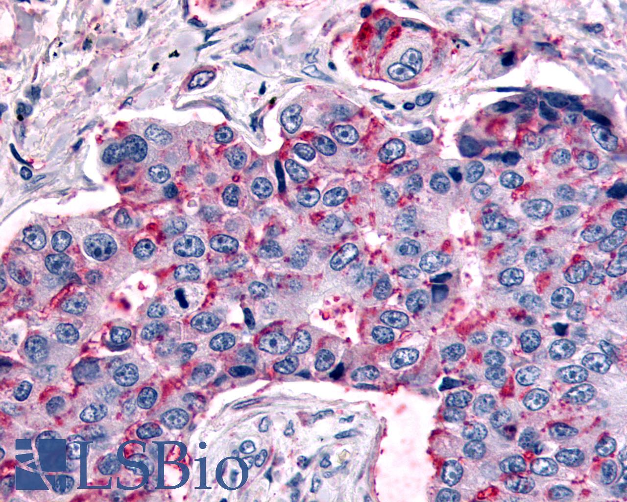 MRGPRX4 / MRGX4 Antibody - Anti-MRGPRX4 / MRGX4 antibody IHC of human Lung, Non-Small Cell Carcinoma. Immunohistochemistry of formalin-fixed, paraffin-embedded tissue after heat-induced antigen retrieval.