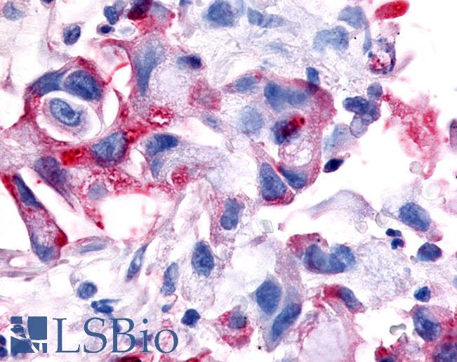 MST1R / RON Antibody - Anti-MST1R / RON antibody IHC of human Pancreas, Carcinoma. Immunohistochemistry of formalin-fixed, paraffin-embedded tissue after heat-induced antigen retrieval.