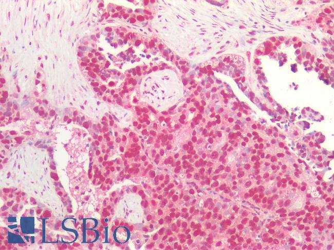 MYC / c-Myc Antibody - Human Ovarian Carcinoma: Formalin-Fixed, Paraffin-Embedded (FFPE)