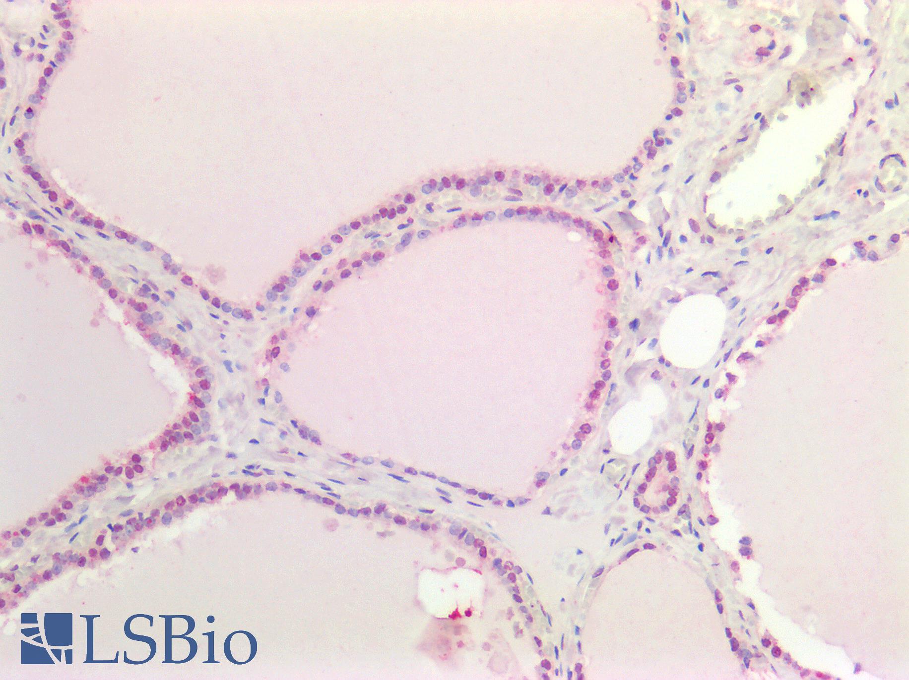 MYC / c-Myc Antibody - Human Thyroid: Formalin-Fixed, Paraffin-Embedded (FFPE)