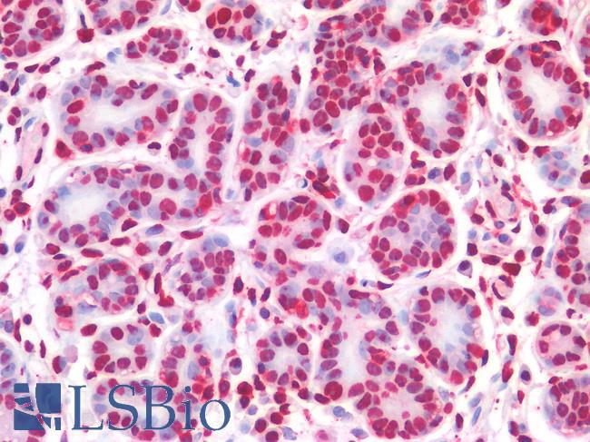NALP3 / NLRP3 Antibody - Human Breast: Formalin-Fixed, Paraffin-Embedded (FFPE)