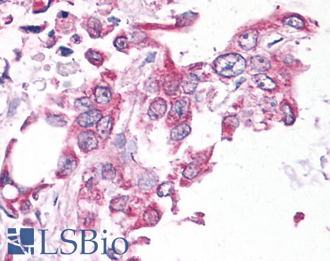 NEK6 Antibody - Pancreas, Carcinoma