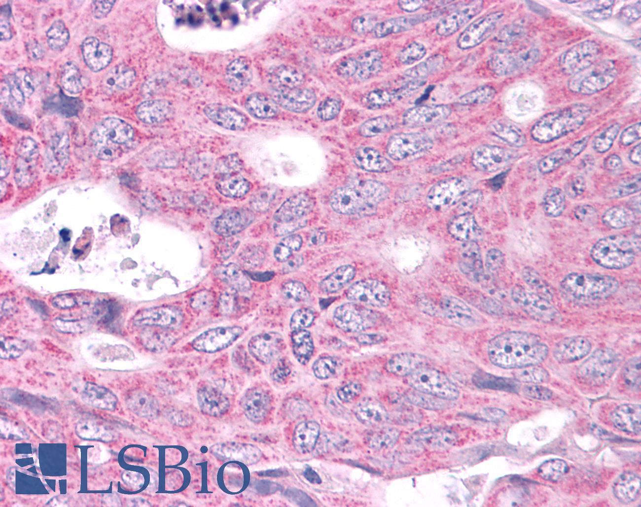 NEK6 Antibody - Colon, Carcinoma
