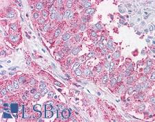 NEK6 Antibody - Anti-NEK6 antibody IHC of human Lung, Non-Small Cell Carcinoma. Immunohistochemistry of formalin-fixed, paraffin-embedded tissue after heat-induced antigen retrieval.