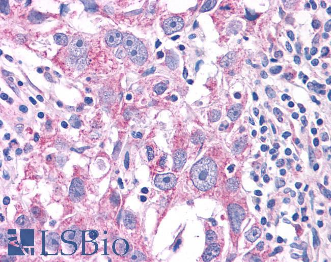 NEK6 Antibody - Breast carcinoma