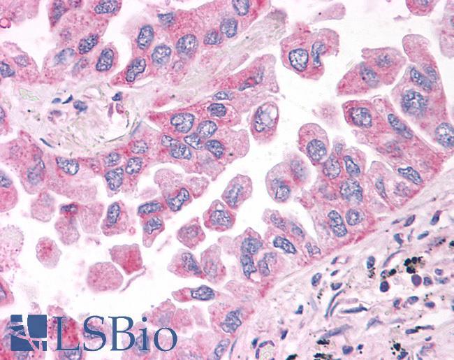 NEK6 Antibody - Lung, Non Small-Cell Carcinoma