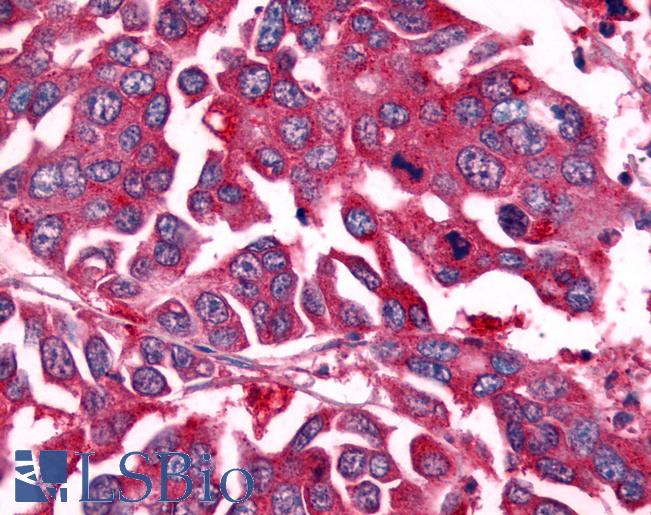 NEK7 Antibody - Colon, Carcinoma