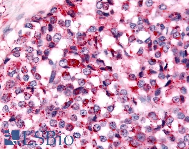 NEK7 Antibody - Anti-NEK7 antibody IHC of human Breast, Carcinoma. Immunohistochemistry of formalin-fixed, paraffin-embedded tissue after heat-induced antigen retrieval.