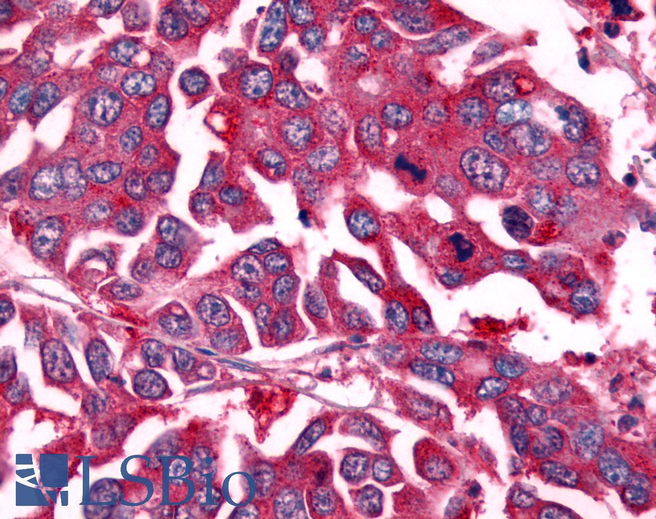 NEK7 Antibody - Colon carcinoma