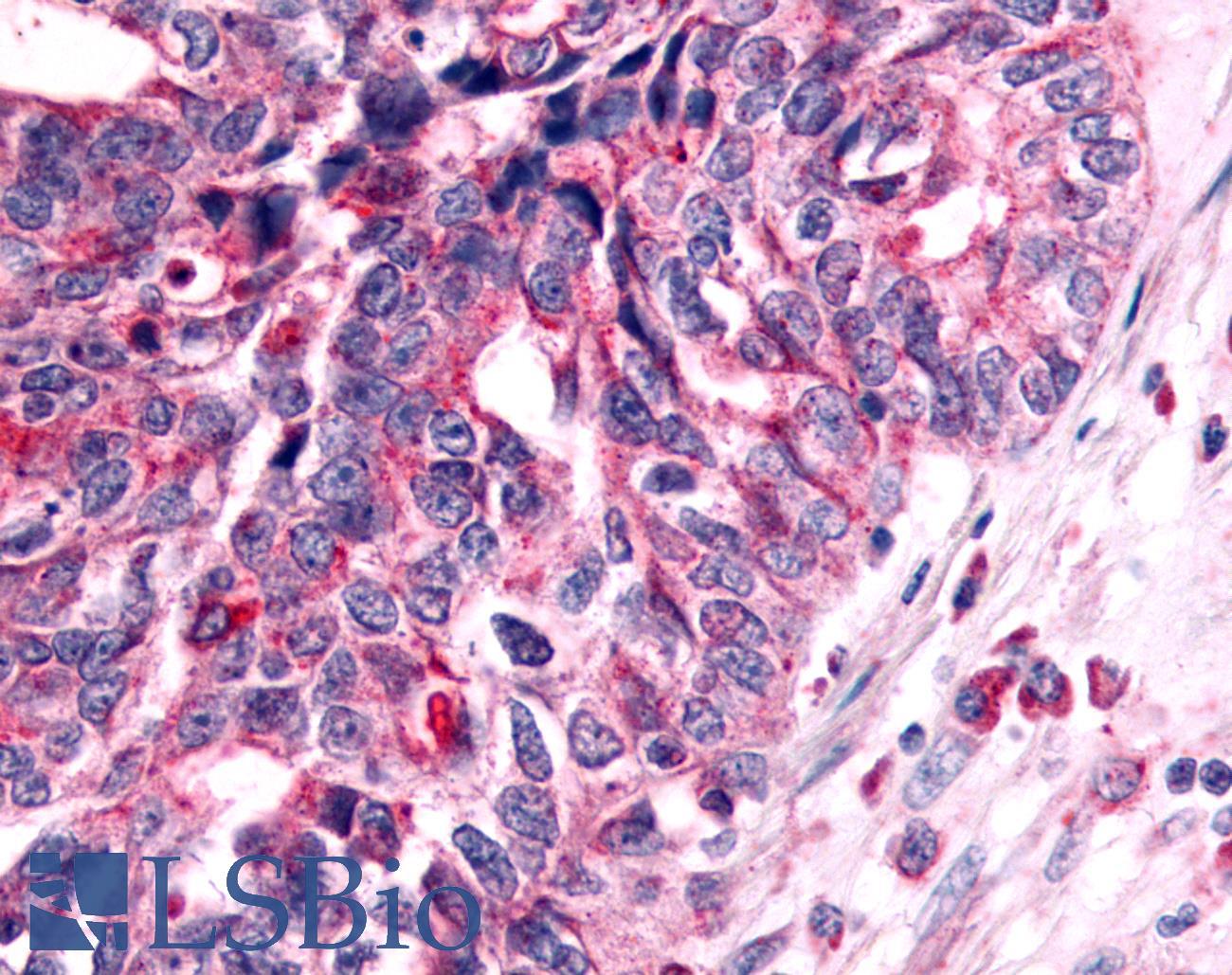 NEK7 Antibody - Ovary, carcinoma