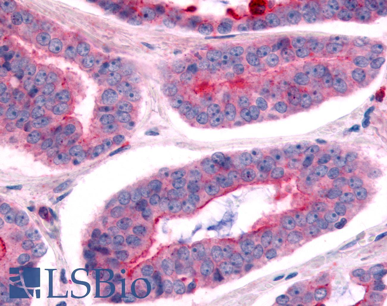 NEK7 Antibody - Prostate, Carcinoma